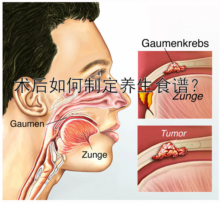 术后如何制定养生食谱？